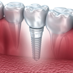 Implantologia dentale - anteprima